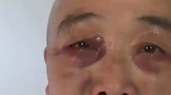 七旬大爷出门散步被拉去割眼袋：一个关于医疗美容行业伦理与老年人保护的警示